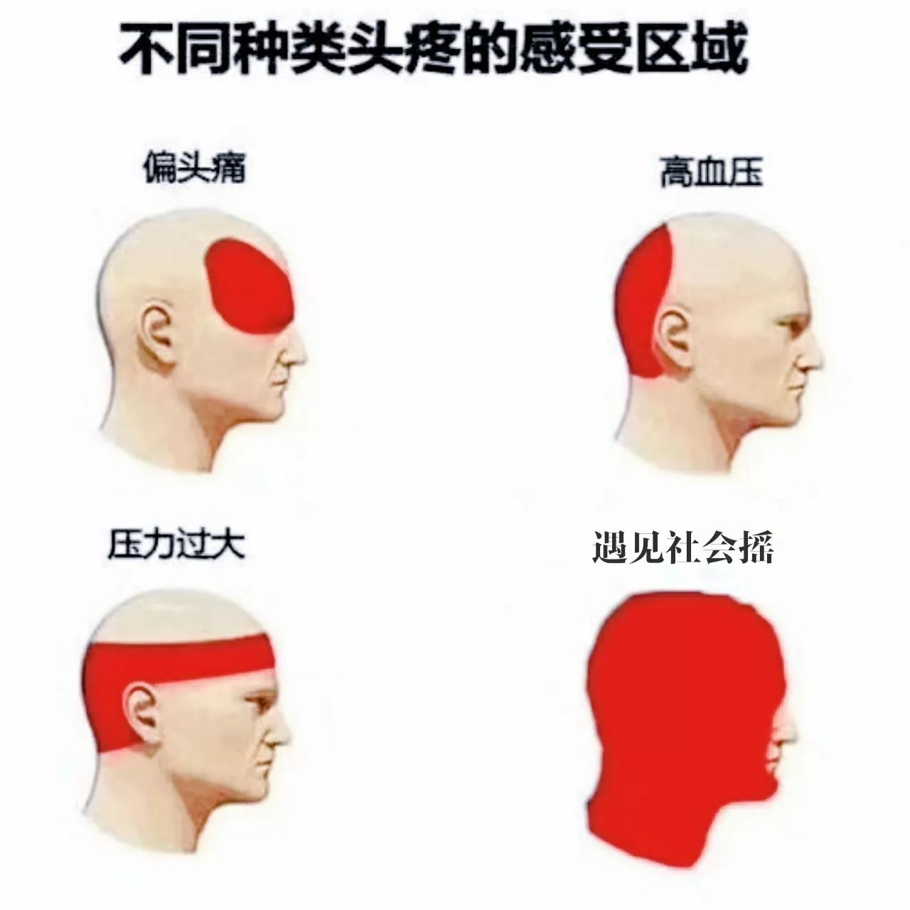 头痛最新分类指南,如何准确完成头痛的分类与诊断