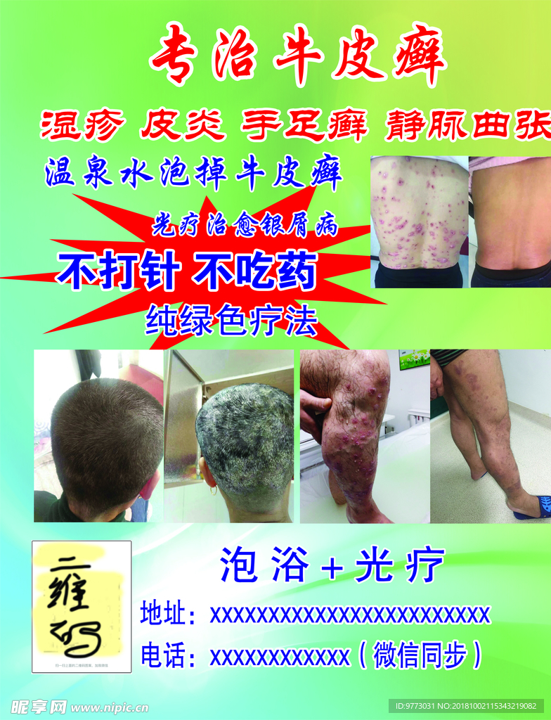 牛皮癣最新治疗方法探索,小巷深处的秘密小店经验分享
