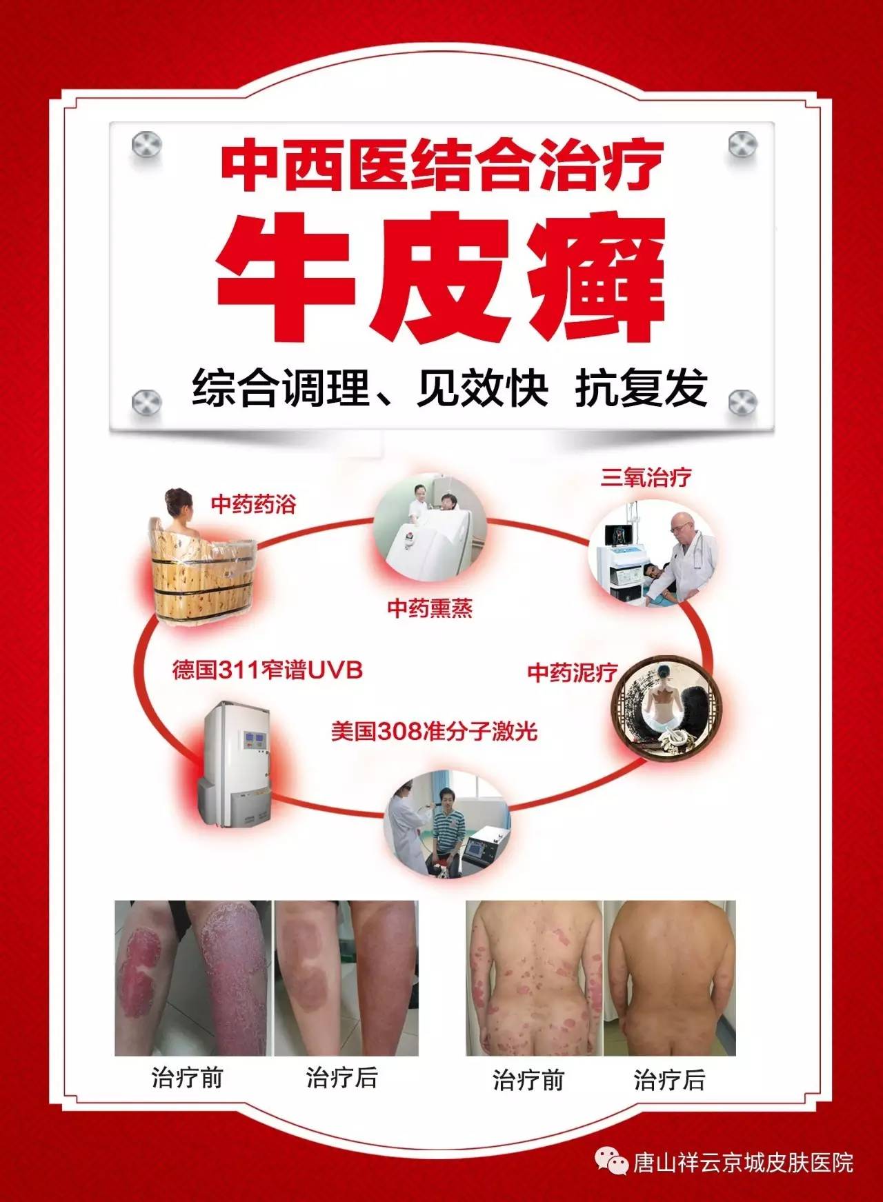 牛皮癣最新治疗方法探索,小巷深处的秘密小店经验分享
